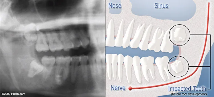 wisdom teeth before and after