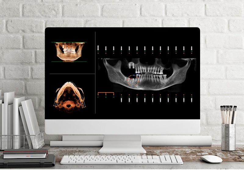 iCAT dental implant patient diagnostic images on a monitor
