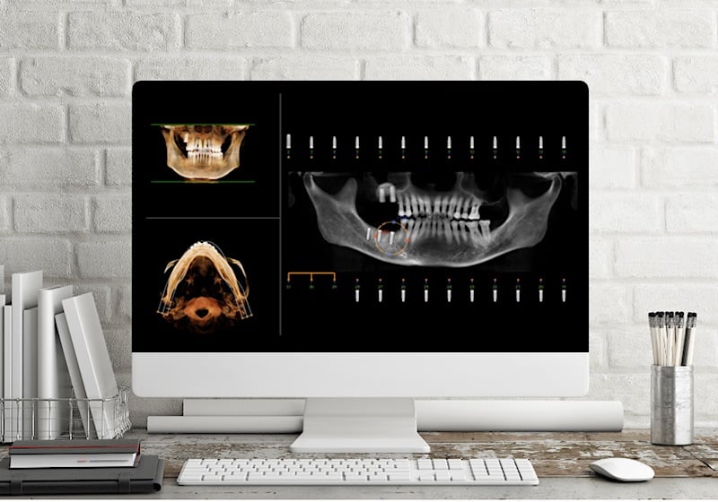 iCAT dental implant patient diagnostic images on a monitor